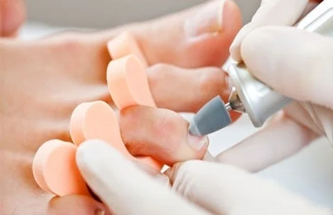 Педикюр при грибку нігтів робиться апаратом