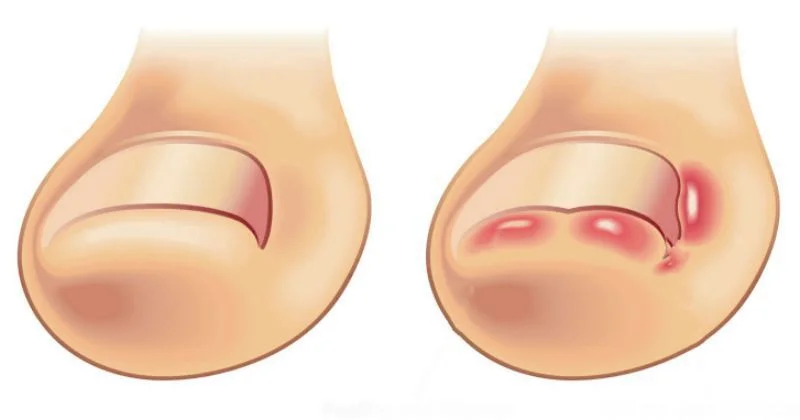 Врослий ніготь на великому пальці ноги лікування потребує обов'язкового